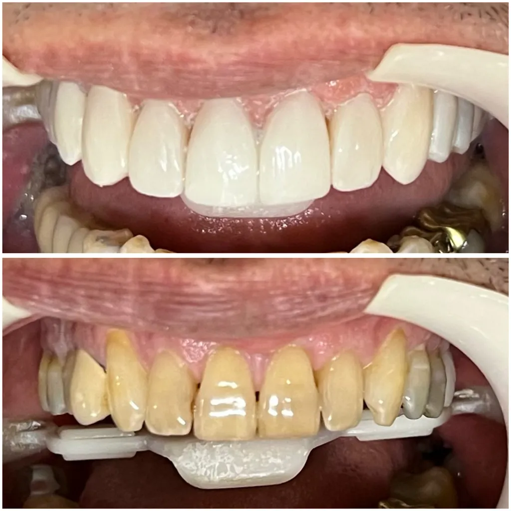 Antes e depois, resultado clínico após tratamento com prótese sobre implante