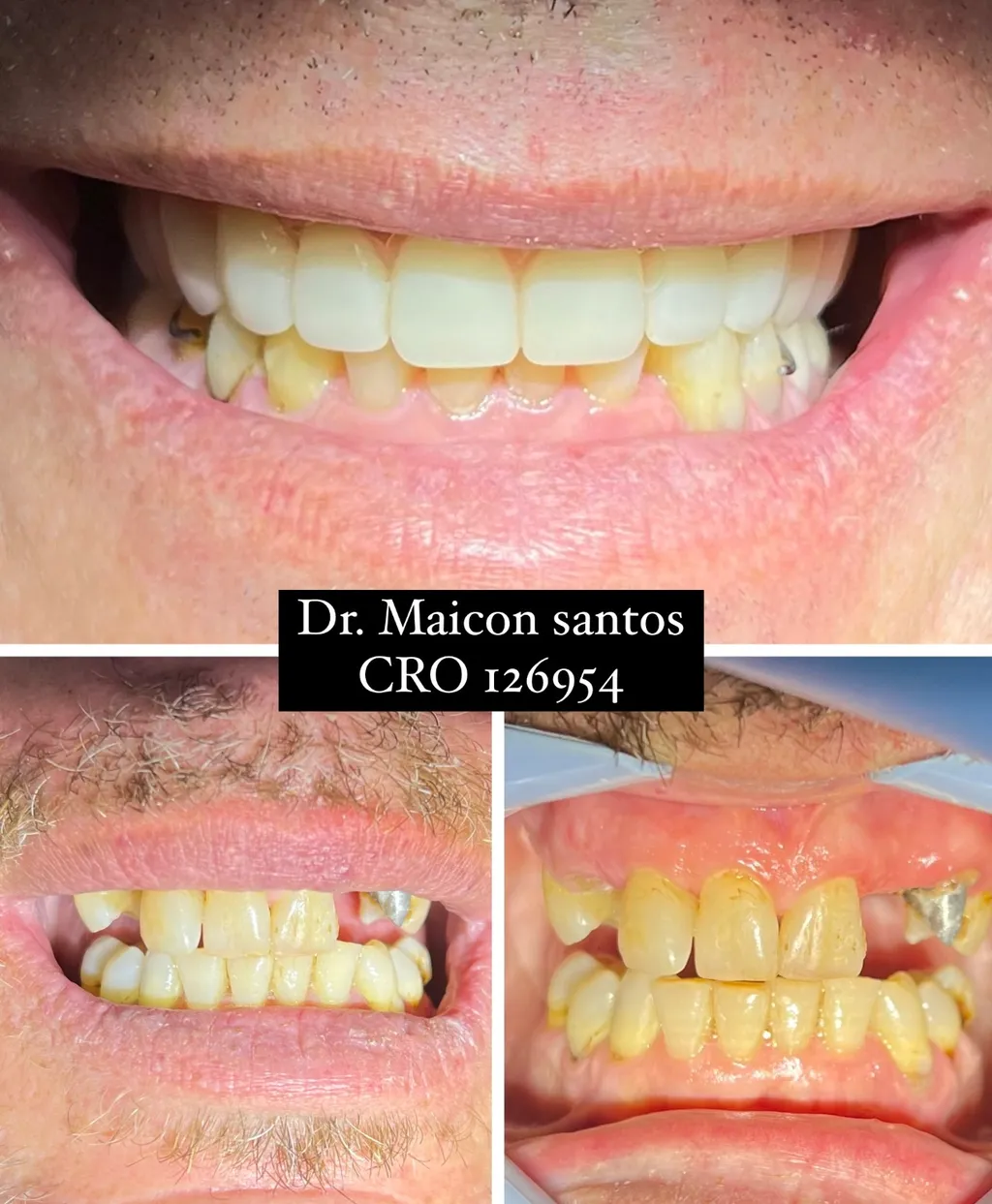 Transformação de vida com implantes dentários