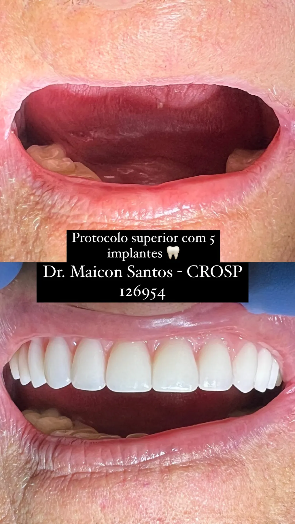Antes e depois, resultado de protocolo superior com 5 implantes