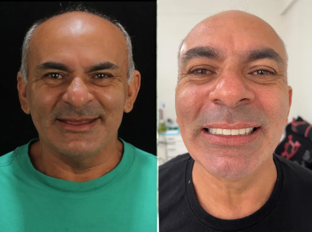 Antes e depois de paciente que realizou protocolo dentário em Santos com Dr. Maicon
