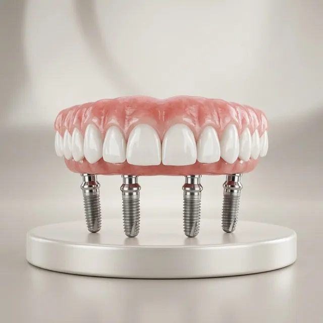 Ilustração 3D de um Protocolo Dentário de Carga Total (All-on-4)