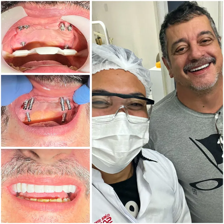 Pessoas felizes jantando ao redor de uma mesa, comendo carne e sorrindo, efeito do implante dentario